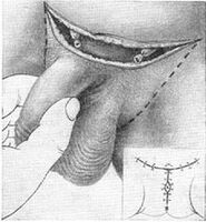Surgical penis enlargement by removing its hidden part
